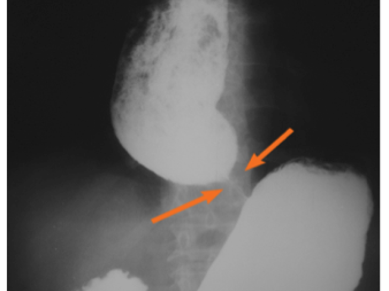 Tratamiento de acalasia - C. llerena